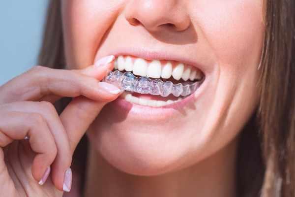 invisalign Nottingham